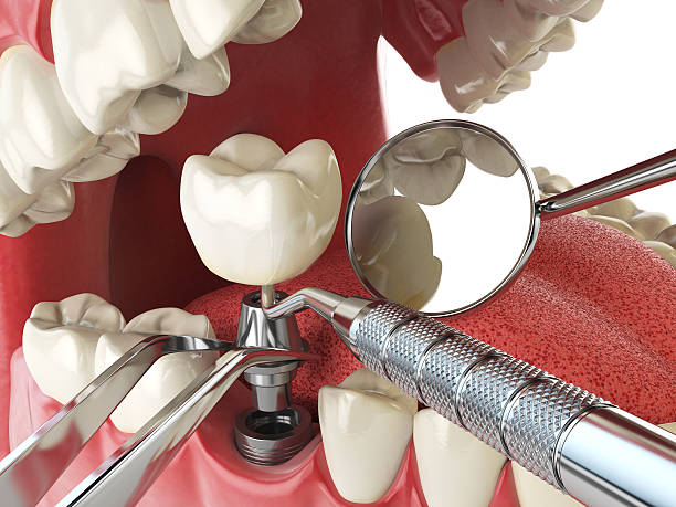 Best Emergency Tooth Extraction in Oak Grove, VA